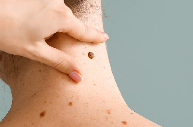 Skin Tag Removal in Dubai